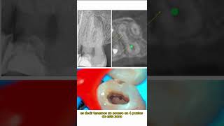 Segundo molar superior con fusión radicular entre MV y P istmo y 5 conductos [upl. by Eisned]