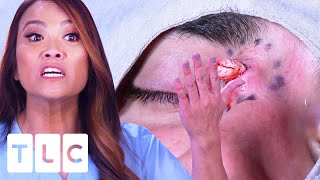 quotIt Could Push My Eye Out Of The Socketquot A Dangerous Eye Cyst  Dr Pimple Popper [upl. by Atsira]