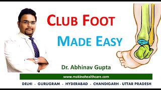 Congenital Talipes Equinovarus Varus CTEV  Club foot  Made easy with Dr Abhinav Gupta [upl. by Cacilia219]