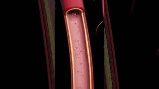 Atherosclerosis The Silent BuildUp [upl. by Ilamad]