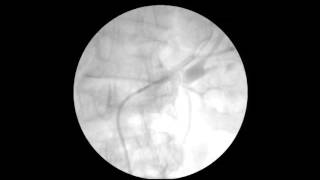 Angioplastia Renal  Renal Artery Stenting [upl. by Shiri]