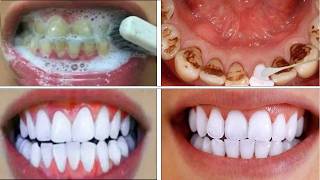 Remove Black Stains on Teeth at Home in 3 Minutes  Natural Teeth Whitening Method [upl. by Laurin]