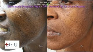 Best Dermatosis Papulosa Nigra Removal in Los Angeles [upl. by Kosaka]