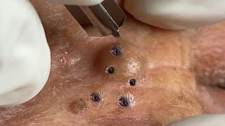 Big Cystic Acne Blackheads Extraction Blackheads amp Milia Whiteheads Removal Pimple Popping  9168 [upl. by Ennayr]