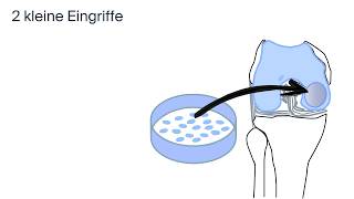 Behandlung Knorpelschaden by ATOS Kliniken [upl. by Marketa]