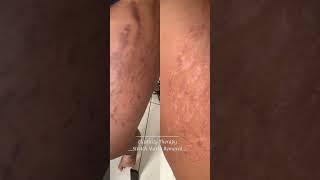 Stretch mark removal for Indian skin tones [upl. by Elletnahs]