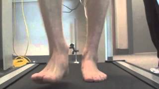 Arthritis big toe Video Gait Analysis Orthotics heel pain Mississauga Brantford Podiatry Chiropody [upl. by Ha]