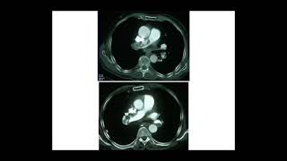 EMBOLIE PULMONAIRE Pr M METAHRI [upl. by Trinl]