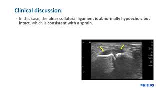 Philips Lumify case study Gamekeeper’s thumb by Jon Jacobson MD [upl. by Berta]