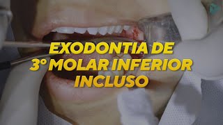 EXODONTIA DE TERCEIRO MOLAR INCLUSO  CIRURGIA [upl. by Eneluj844]