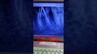 Root canal treatment for grossly carious painful tooth to relieve pain rootcanal dentaltreatment [upl. by Ventre]