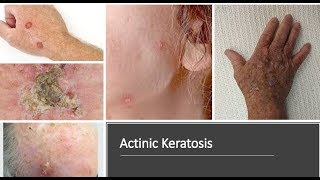 Actinic Kearatosis Solar Keratosis  Causes Diagnosis Symptoms Treatment Prognosis [upl. by Burnaby246]