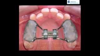 Palatal Expansion  RPE at Orleans Orthodontics [upl. by Akeihsat]