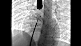 Septal Occluder release across the ASD [upl. by Okoyik]