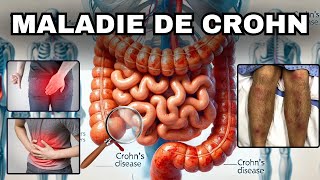 SYMPTÔMES les plus fréquents de la MALADIE DE CROHN [upl. by Ingeberg645]