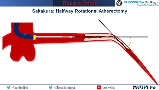 Halfway Rotational Atherectomy [upl. by Willow]