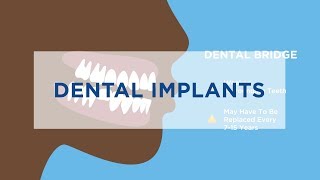 Dental Implants vs Dentures 15 [upl. by Thorn261]