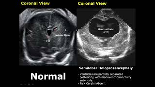 Fetal Brain Ultrasound Normal Vs Abnormal Image Appearances Comparison  Fetal Brain Pathologies USG [upl. by Olney95]