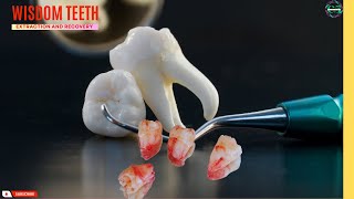 Wisdom Teeth Extraction  Surgical removal and recovery wisdomteeth dentist health [upl. by Trebornhoj]