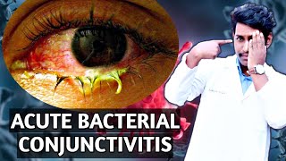 acute mucopurulent conjunctivitis acute bacterial conjunctivitis conjunctivitis in the eye 2021 [upl. by Eedeed]