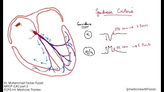 How to diagnose myocardial infarction in LBBB – Sgarbossa Criteria [upl. by Athey]