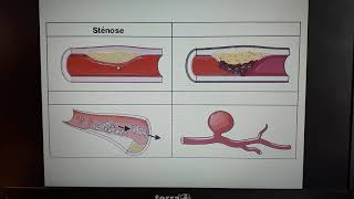 1ST2S Vidéo 5 lathérosclérose [upl. by Pascal]