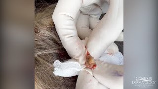 Extracting a Pilar Cyst Pilar Cysts Can Haunt Your Scalp  CONTOUR DERMATOLOGY [upl. by Emile]