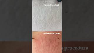 Microneedling smagliature [upl. by Dola]