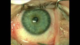 Removal of Sutures from Penetrating Keratoplasty [upl. by Udela]