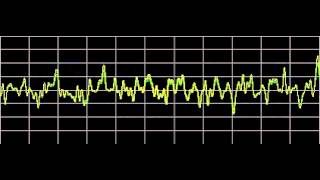 Cluster Headaches  Rife Frequencies [upl. by Sasnett]