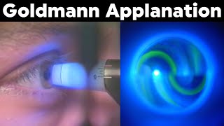 Goldmann Applanation Tonometry Procedure Technique Tutorial [upl. by Nhor51]