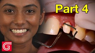 HOW TO Place Zirconia Crowns on ANTERIOR Teeth 7 amp 10 [upl. by Assile]