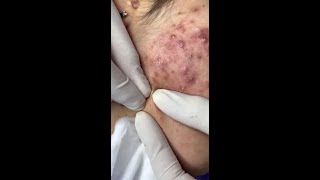 Best Pimple Popping 10 beautiful blackheads sacdepspa [upl. by Vladamir753]