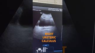 Right URETERIC CALCULUS usg radiodiagnosis usgs radiologist calculus clinicalcase radio [upl. by Ardnasal]