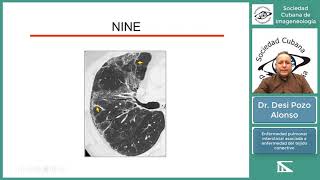 Enfermedad pulmonar intersticial asociada con enfermedad del tejido conectivo [upl. by Ainat]