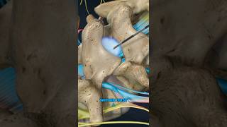 Lumbar Epidural Steroid Injection 3D Animation [upl. by Earised]