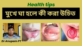 মুখে ঘা হলে কি করণীয়canker sore treatmenthealthtips bangla dranupampt [upl. by Amlev]