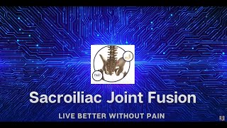 Sacroiliac Joint Stabilization for Back Pain  with Omnia Medical’s PSiF Allograft [upl. by Wardieu]