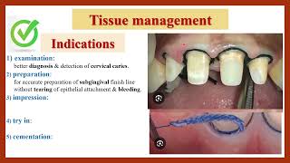 Tissue Management Gingival Retraction Indications amp Requirements دواعي ابعاد اللثة ومتطلباتها [upl. by Yamauchi]