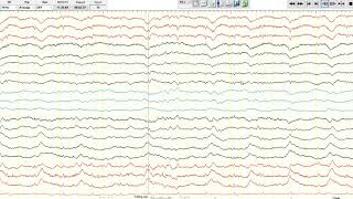 EEG Ictalinterictal continuum [upl. by Arreic]