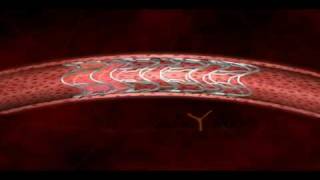 Stent 3D animation done for sahajanand medical technologies [upl. by Anileba452]