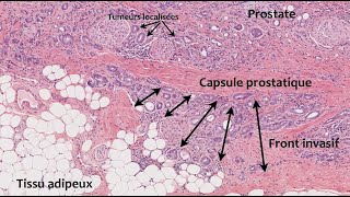 Cancer de la prostate  comprendre son agressivité chez les patients obèses [upl. by Anaimad646]