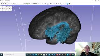 The anatomy of the arcuate fasciculus using diffusion MRI data [upl. by Tamas]