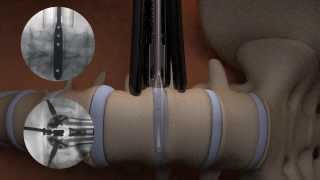 TIMBERLINE® Lateral Fusion System  Surgical Animation [upl. by Chantal]