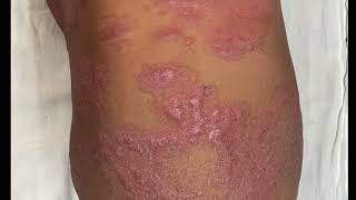 Skin Biopsy Technique Dr Bhawuk Dhir [upl. by Adnahsam131]