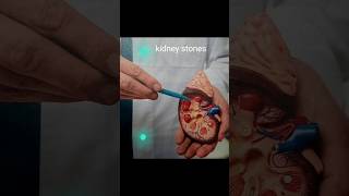 Kidney stones [upl. by Diva]