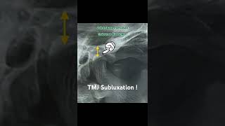 TMJ Subluxation  Radiograph findings  doctor shorts medical surgeon youtubeshorts [upl. by Assel]