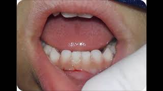 Exodoncia dientes temporales 71 y 81 [upl. by Rosalinde805]