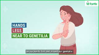 Spotting the Signs Dr Arvind Kumar’s Expert Tips on Monkeypox Symptoms amp Prevention [upl. by Asus141]