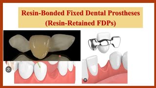 2 Advantages amp Disadvantages of resinbonded FDP بالعربي [upl. by Ocramed]